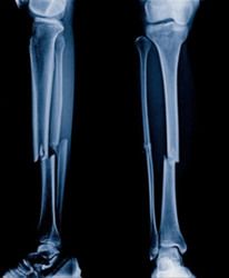X-ray of broken leg bones